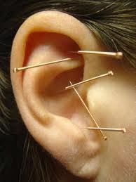 Auricular acupuncture for Chronic Coughing.ent