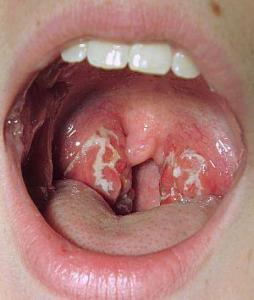 Tonsillitis.Eyiasis.ent