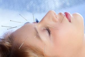 Acupuncture for Facial Nerve Paralysis.ent