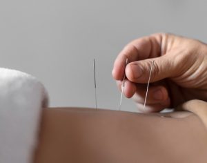 acupuncture needle insertion.ent