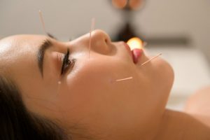 Acupuncture for Facial Nerve Paralysis.ent