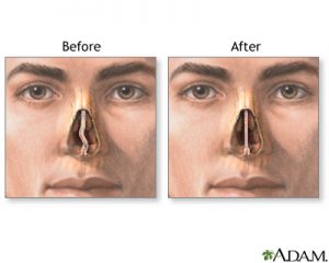 Instructions for Septoplasty: Before and after.ent