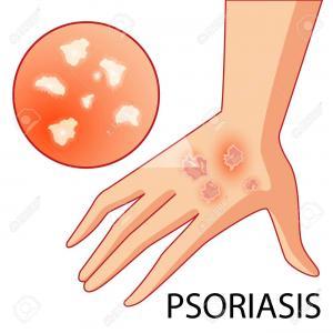  Psoriasis.ent