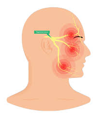 Trigeminal N. Trigger in Migraine.Eviasis.ent